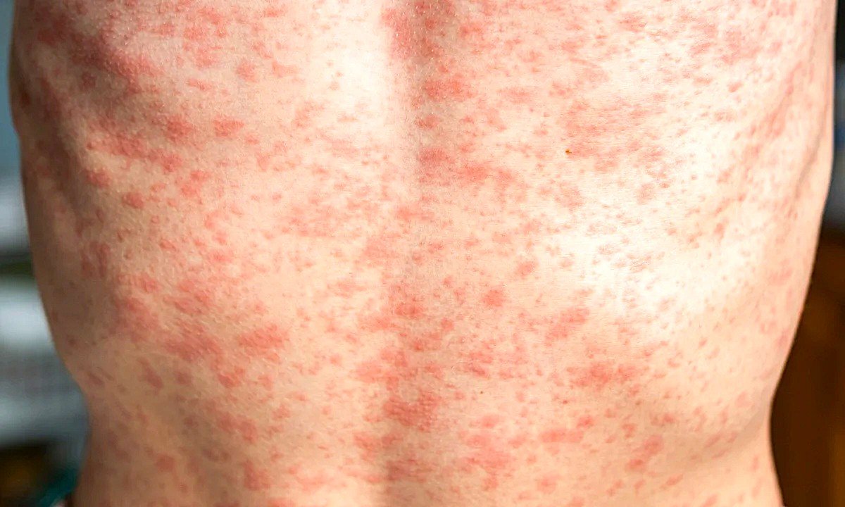 Measles